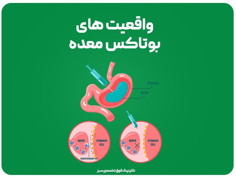 بوتاکس معده: راهی برای لاغری بدون درد و سریع