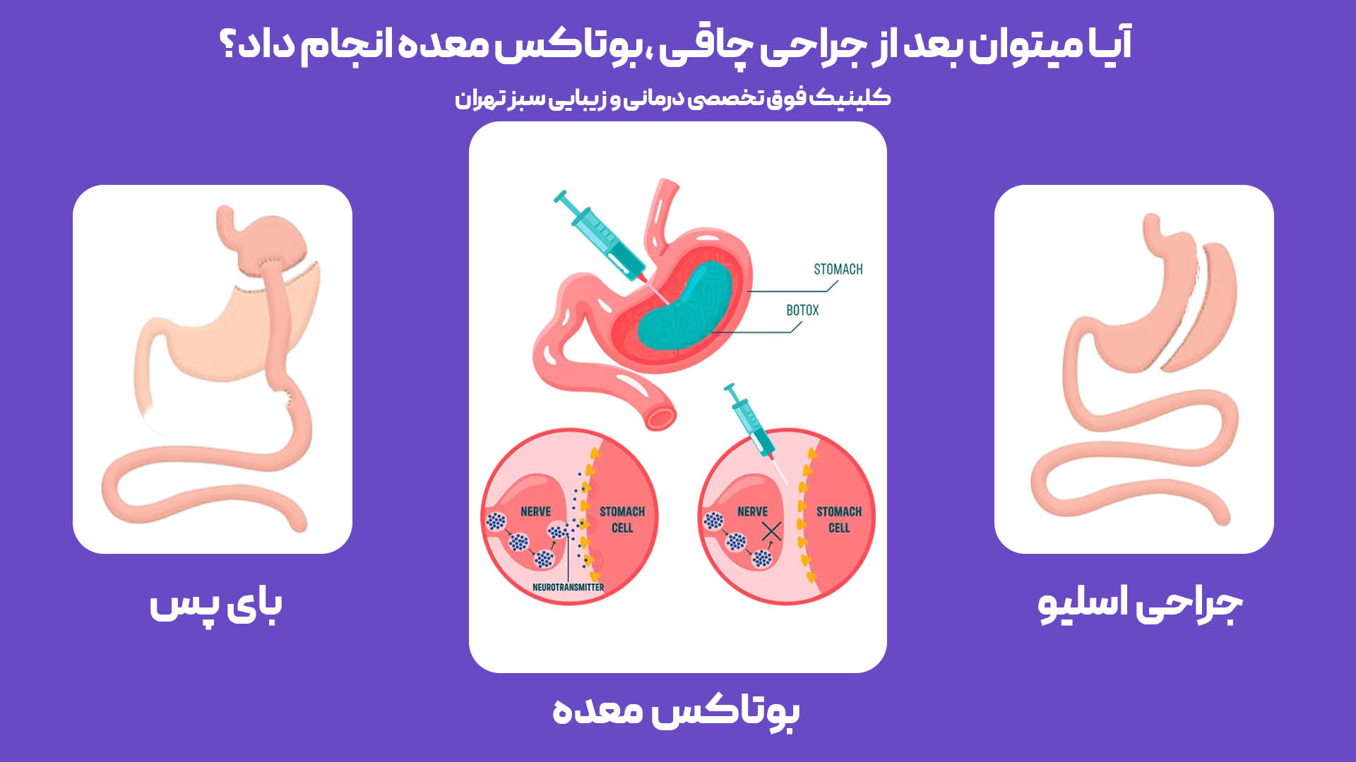 تفاوت اسلیو، بای‌پس و بوتاکس معده